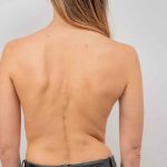 Kondisi Tubuh Skoliosis Dengan Bentuk Keanehan Tulang