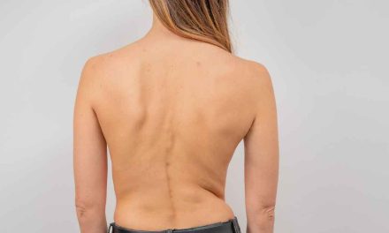 Kondisi Tubuh Skoliosis Dengan Bentuk Keanehan Tulang