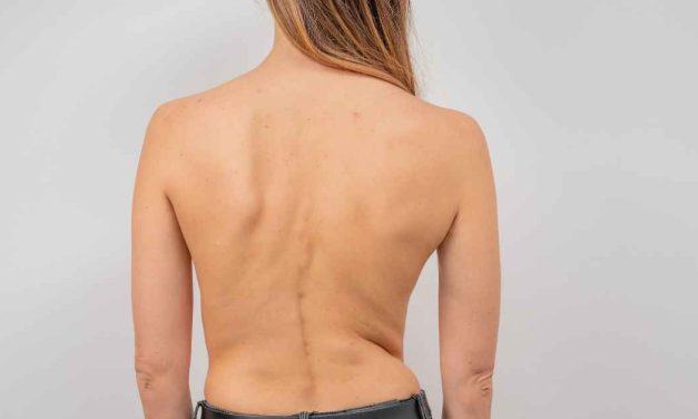 Kondisi Tubuh Skoliosis Dengan Bentuk Keanehan Tulang