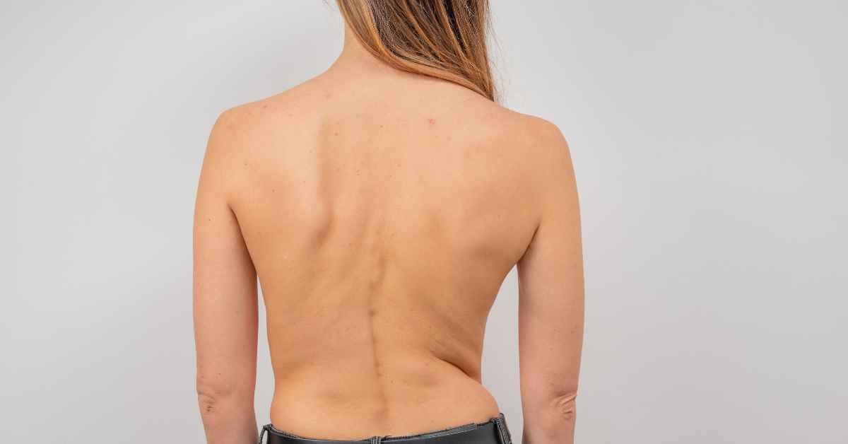 Kondisi Tubuh Skoliosis Dengan Bentuk Keanehan Tulang